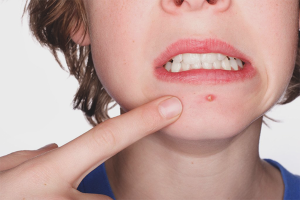 Come sbarazzarsi di acne sottocutanea sul mento