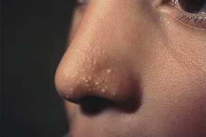 How to get rid of white dots on your face
