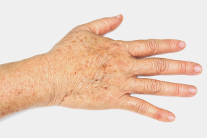How to get rid of age spots on the hands