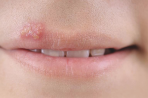 How to get rid of a cold on the lip
