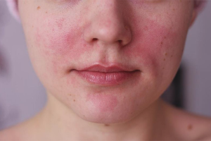 How to get rid of rosacea on the face