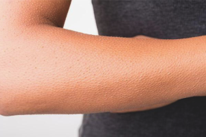 How to get rid of goosebumps on your hands
