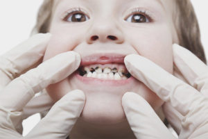 Placa negra en los dientes de un niño