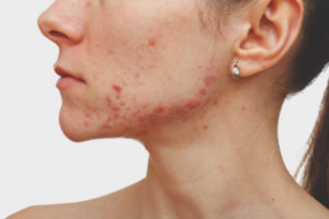 Acne on the chin in women