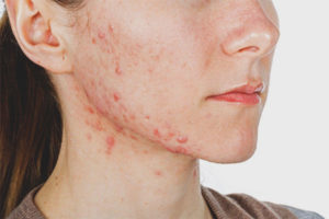 Acne on the cheekbones of women