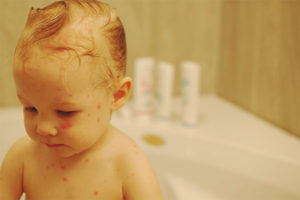 Is it possible to bathe a child during chickenpox